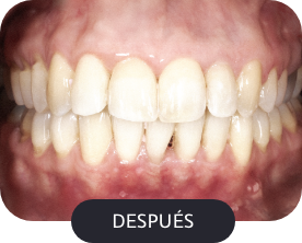 despues-1