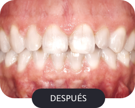 despues-3