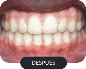 despues-4